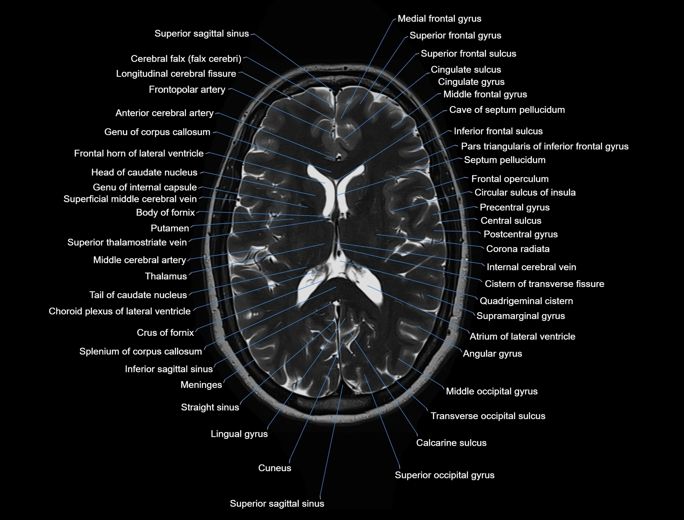 MRI Brain axial cross sectional radiology anatomy 3T image  -img-00001-00032.webp